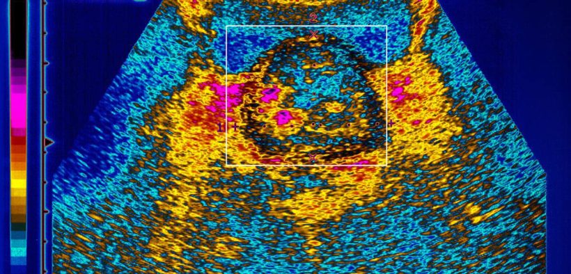 U.S. launches study to understand blacks and prostate cancer